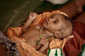 Three more children died in Tharparkar due to malnutrition