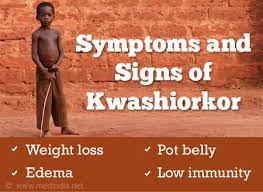 Kawashiorkor causes famine