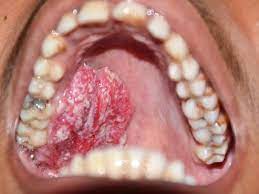 Mouth cancer