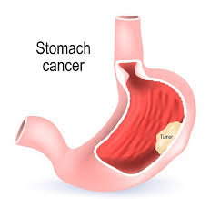 Stomach cancer-