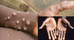 Canada confirms 15 cases of monkeypox